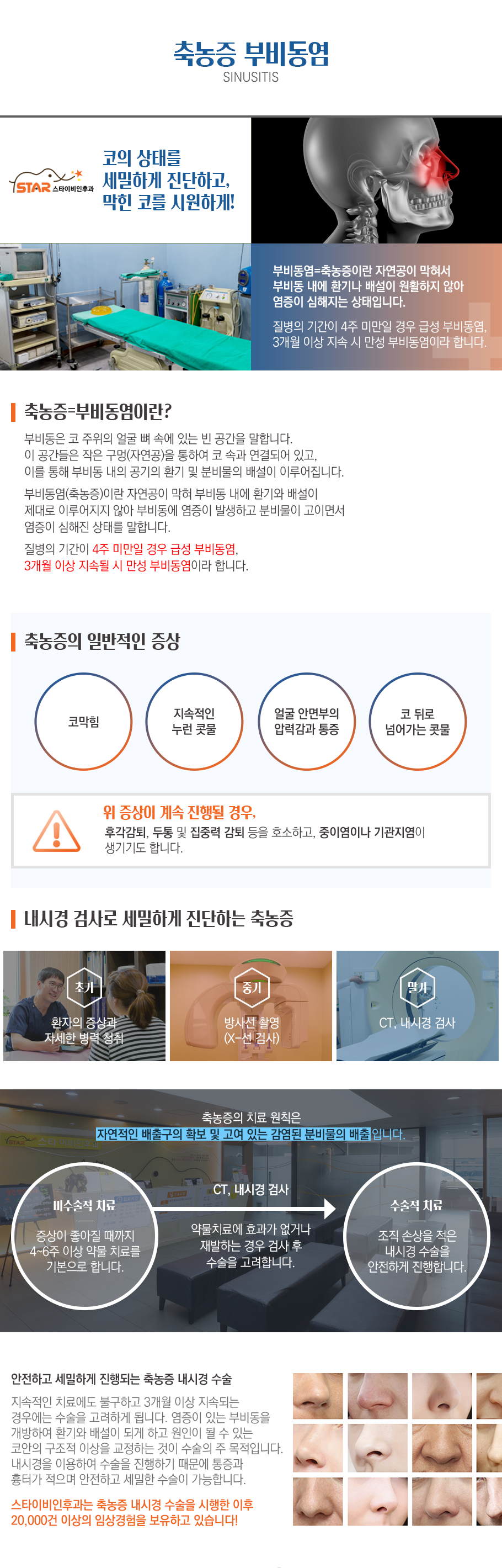 축농증=부비동염